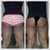 I know it's too soon but I definitely want to have it done a second time.  1) to get it more smooth and even. 2) I want to de-bulk my upper thighs a little bit more & and actually have it done all the way down to my knees.