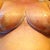 15 days post op. I have silicon cups over my areolas