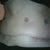 3.5 months post op