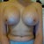 6 weeks post op
