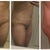 Day 5 Post Op. I feel SO much better with out that horrible drain! Swollen but feeling alright. Not really in any pain, just discomfort. I have been STARVING, but I guess that is due to all the healing going on! The incision is covered in steri-strip (or whatever it is called). I still have one stitch on each place the lipo tool went into my inner thighs. My inner thighs feel bruised today- I hadn't had any pain from them before now. They are still swollen.