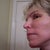 Healing 10 days After Surgery - no make-up