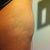 this bulge was not here before, is this just swelling? im 6-7 weeks post op. I have no lumps in my tummy or hips.