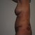 12 days post-op