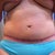 faded purple of scar using scaraway strips (pubis still swollen)