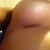 Right incision. Will use biocorneum tonight!