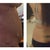 Before lipo, and then the first day after lipo
