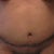 2 weeks post-op