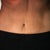 One Year Post-op.. old stretch marks