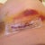 Bruising Day 5
