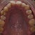 My top teeth before Invisalign and the extraction.