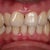 A front view of my teeth before Invisalign