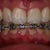 A front view of my teeth during braces!  You can see the progress on the top and my attachments.