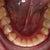 My bottom teeth after braces and Invisalign!  I am getting more trays for the bottom, but if this had been the end of my treatment, I would still be happy.