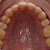 My top arch!  I am about to enter refinement, but again, if this was the end of my treatment, I would be thrilled.
