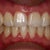 An almost finished product!  You may notice part of my gum is puffy on the right hand side.  This was because I had just gotten my braces off and the tissue was irritated.
