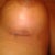 Incision on left breast, postop day 2