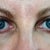 3 weeks: Bruise under right eye is almost gone though there is still a dark shadow underneath.
