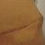 3 months - As the swelling goes down, this is more apparent.  In Sept I will have it removed.