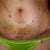Steri strips off