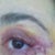 If you look at this picture of the stitches it seems much thicker them any others that I've seen. Has anyone ever seen them like this? Hoping scar won't heal thick but it feels like a big ridge now. :(