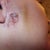 Burn 8 days after 