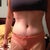 4 Days PO.  VERY pleased with my waist.  Dr. Gervais is a genius!