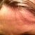 Day 40 after fraxel 1st tx- forehead straight