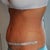 14 days PO right angle view