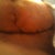 1 week post op left side