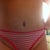 Still some swelling on my tummy area, flanks too, Ill be doing coolsculpting I think