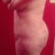 4 weeks post op