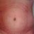 post op