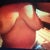 back in the day...(6 weeks pre op)