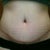 scar appears to be reder than it is, but still looking for a good scar treatment