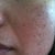 5 days after, left.