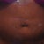 Stomach 1 day after surgery