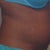 Side Day 4 post op
