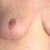 post op 1 month