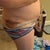 left 3 days post op
