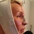3rd night in, a bit of swelling but deprojection is already visible in my profile!