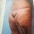 My thighs before surgery