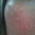 5 days after fraxel, right.