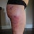 right lateral thigh, 2 days post procedure