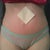 2 weeks post op