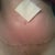 2 week post op incision healing nicely