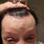 My Browlift has left it all LUMPY and horrible and veins