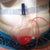 Compression Garment and drains!  Ever so lovely!