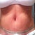 3 days post op.  I LOVE my new tummy, swelling and all!