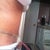 3 days post op side view.  You can see I am still hunched over!